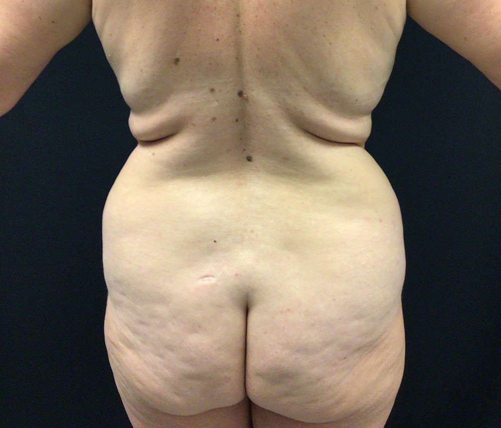 Lipo 360 Before & After Gallery - Patient 102619935 - Image 7