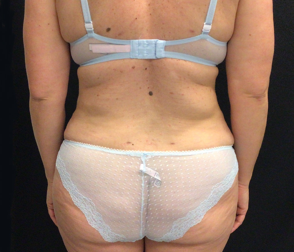 Liposuction Before & After Gallery - Patient 102619935 - Image 8