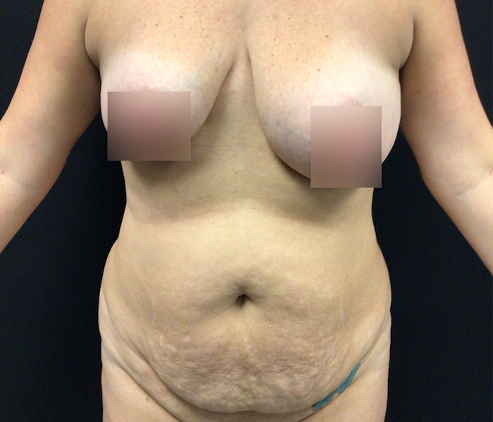 Lipo 360 Before & After Gallery - Patient 102619959 - Image 1