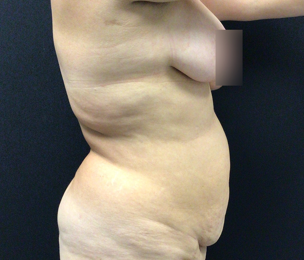 Lipo 360 Before & After Gallery - Patient 102619959 - Image 3