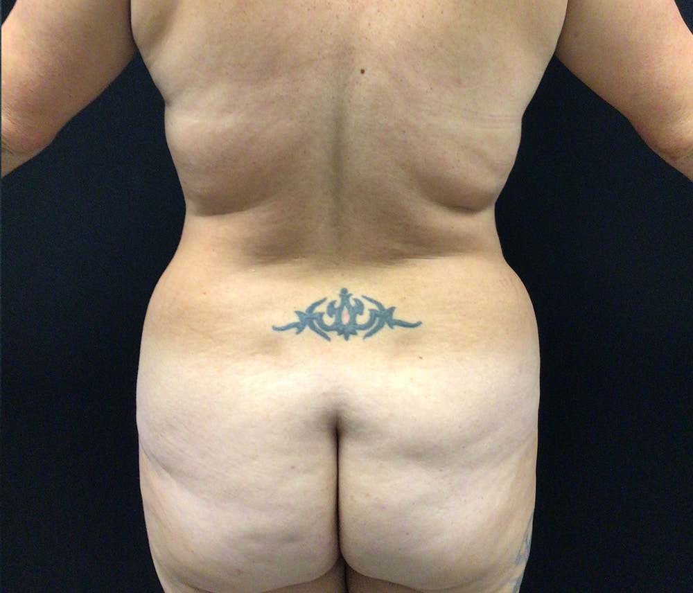 Lipo 360 Before & After Gallery - Patient 102619959 - Image 7
