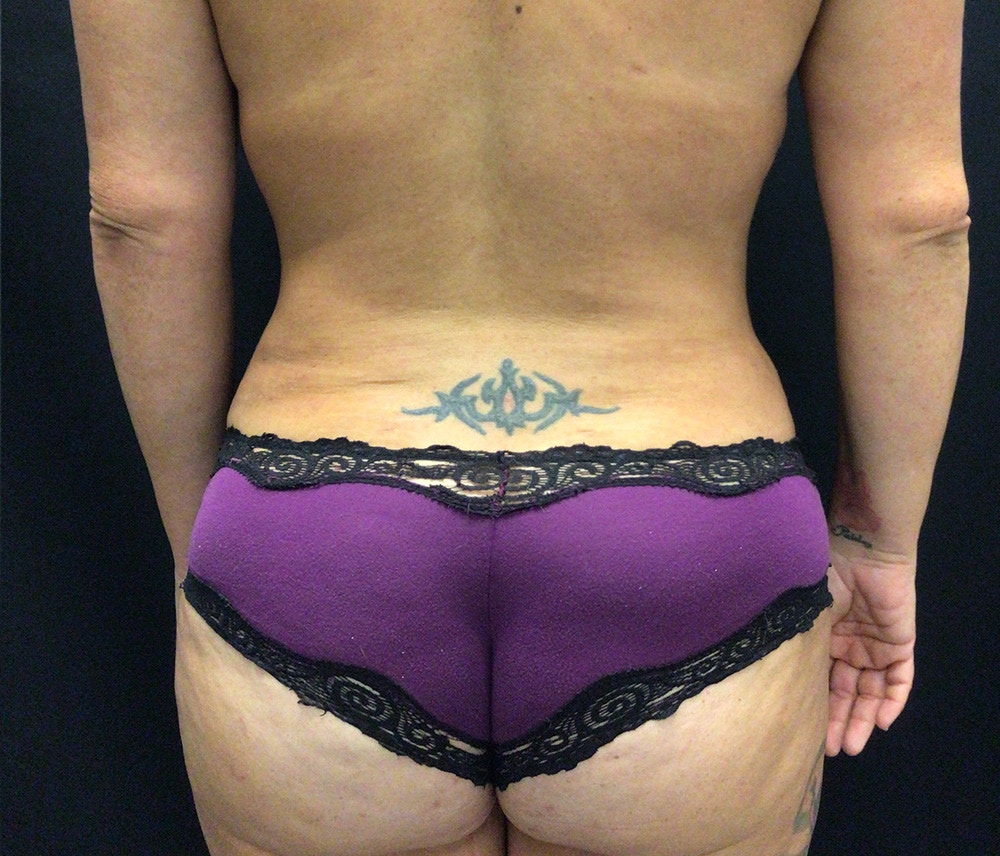 Lipo 360 Before & After Gallery - Patient 102619959 - Image 8