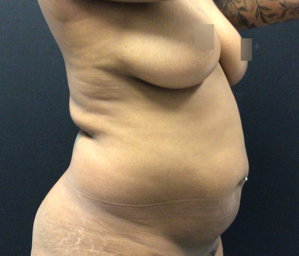 Liposuction Before & After Gallery - Patient 102619989 - Image 3