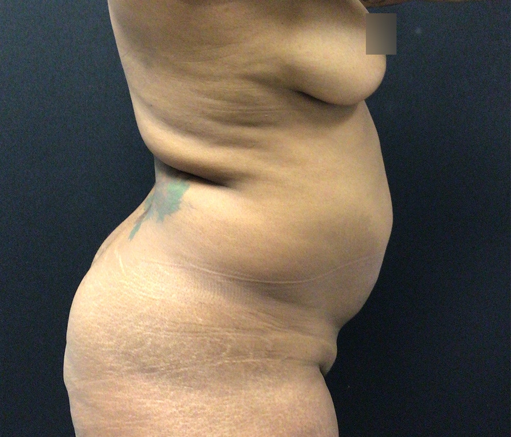 Liposuction Before & After Gallery - Patient 102619989 - Image 5