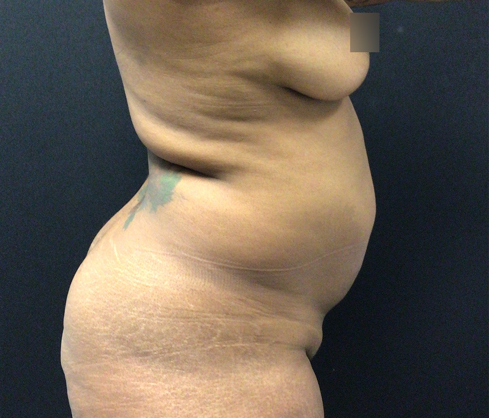 Lipo 360 Before & After Gallery - Patient 102619989 - Image 5