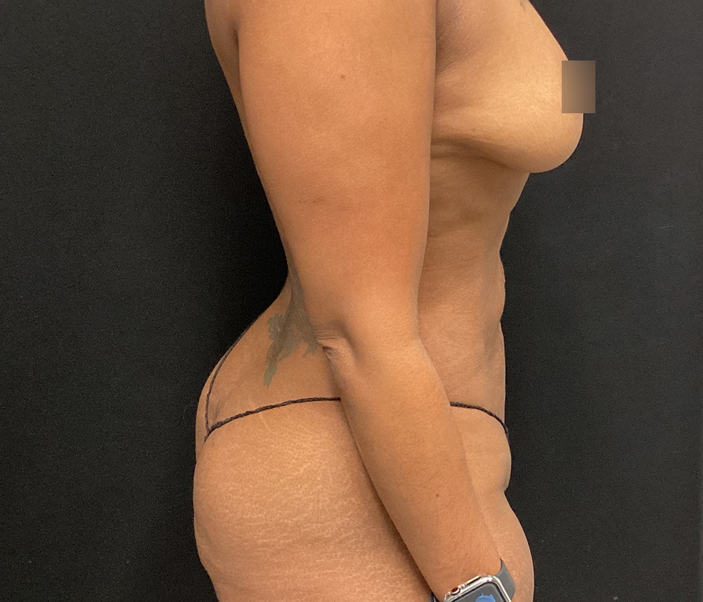 Liposuction Before & After Gallery - Patient 102619989 - Image 6