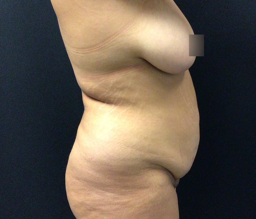 Liposuction Before & After Gallery - Patient 102620016 - Image 3
