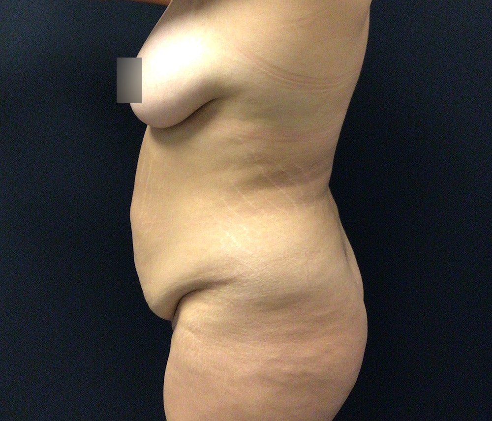 Liposuction Before & After Gallery - Patient 102620016 - Image 5
