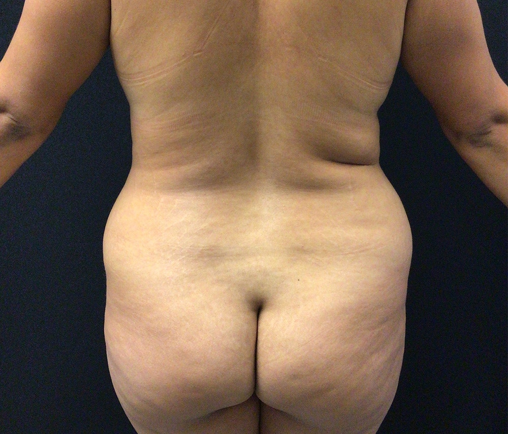 Liposuction Before & After Gallery - Patient 102620016 - Image 7
