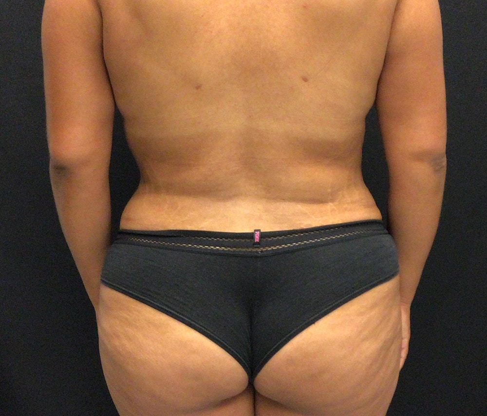 Liposuction Before & After Gallery - Patient 102620016 - Image 8