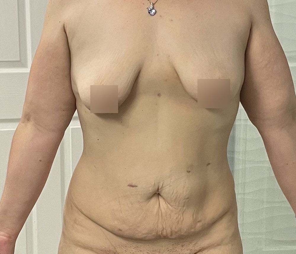 Liposuction Before & After Gallery - Patient 102620043 - Image 1