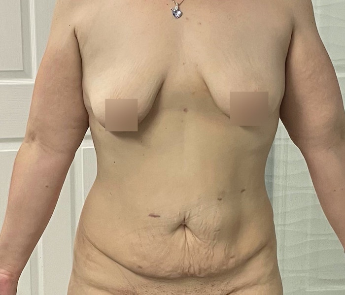 Lipo 360 Before & After Gallery - Patient 102620043 - Image 1