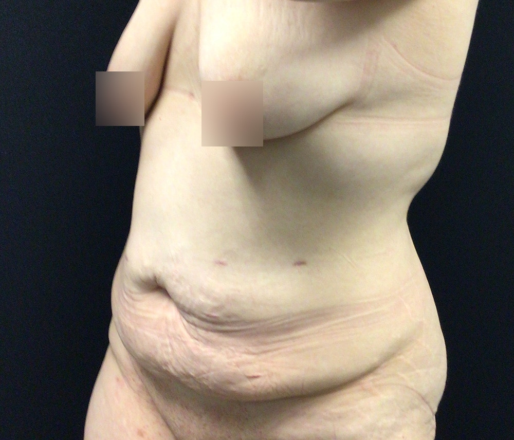 Liposuction Before & After Gallery - Patient 102620043 - Image 3