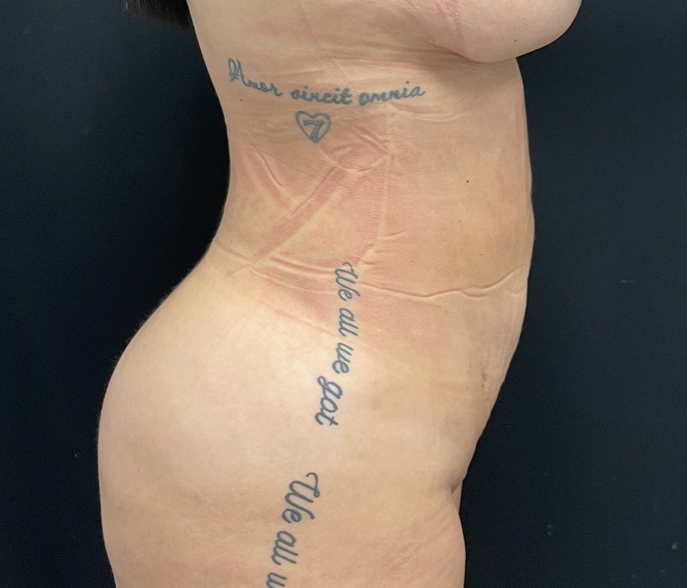 Liposuction Before & After Gallery - Patient 102620134 - Image 4