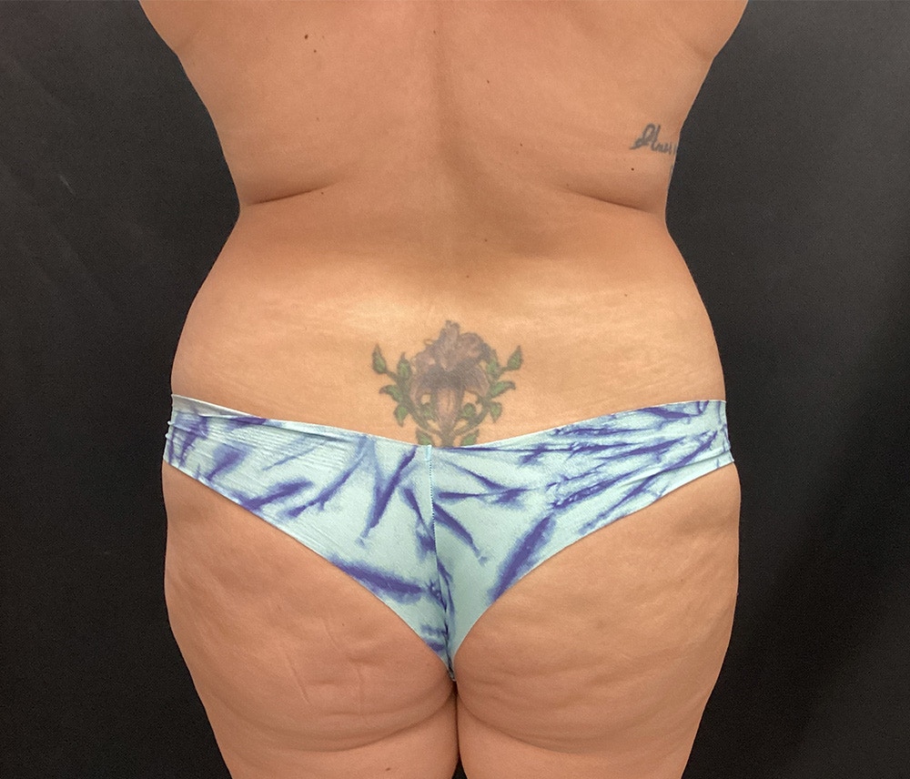 Lipo 360 Before & After Gallery - Patient 102620134 - Image 7