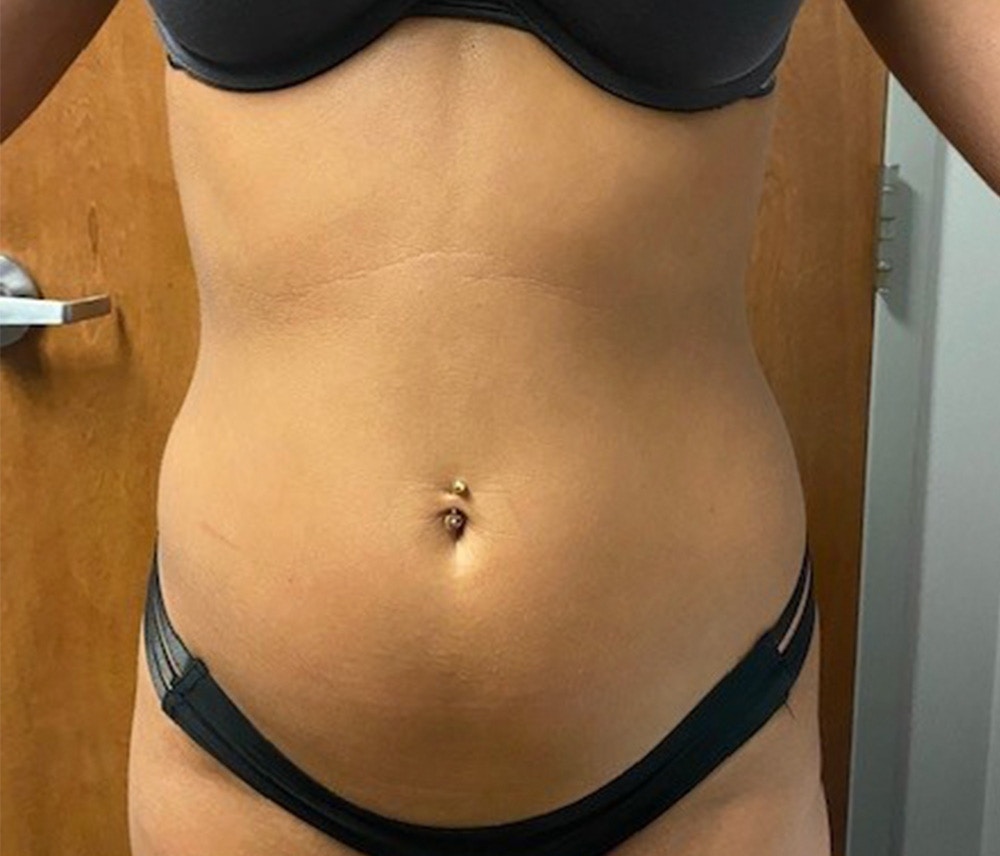 Liposuction Before & After Gallery - Patient 102620133 - Image 1