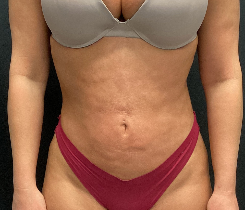 Liposuction Before & After Gallery - Patient 102620133 - Image 2