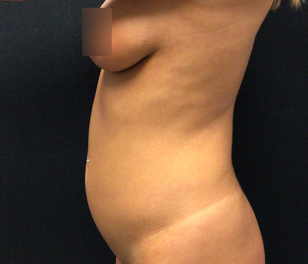 Liposuction Before & After Gallery - Patient 102620133 - Image 5
