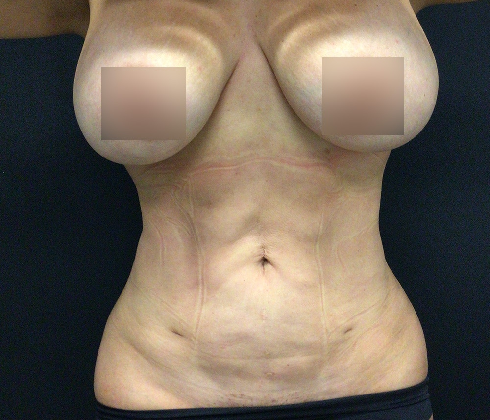 Liposuction Before & After Gallery - Patient 102620132 - Image 2