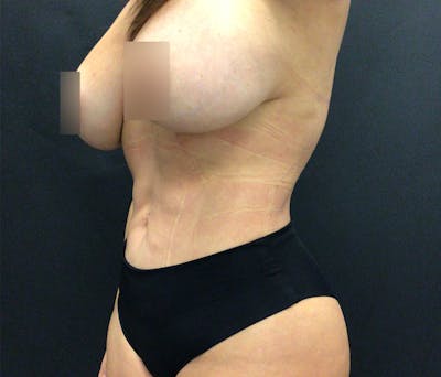 Liposuction Before & After Gallery - Patient 102620132 - Image 4