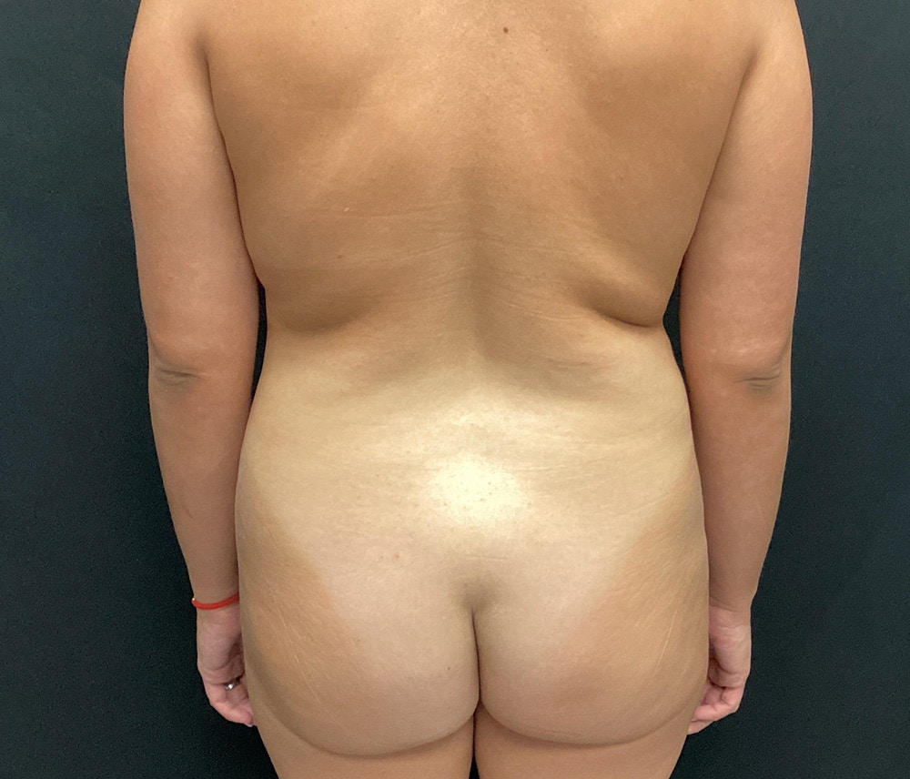 Lipo 360 Before & After Gallery - Patient 102620132 - Image 7