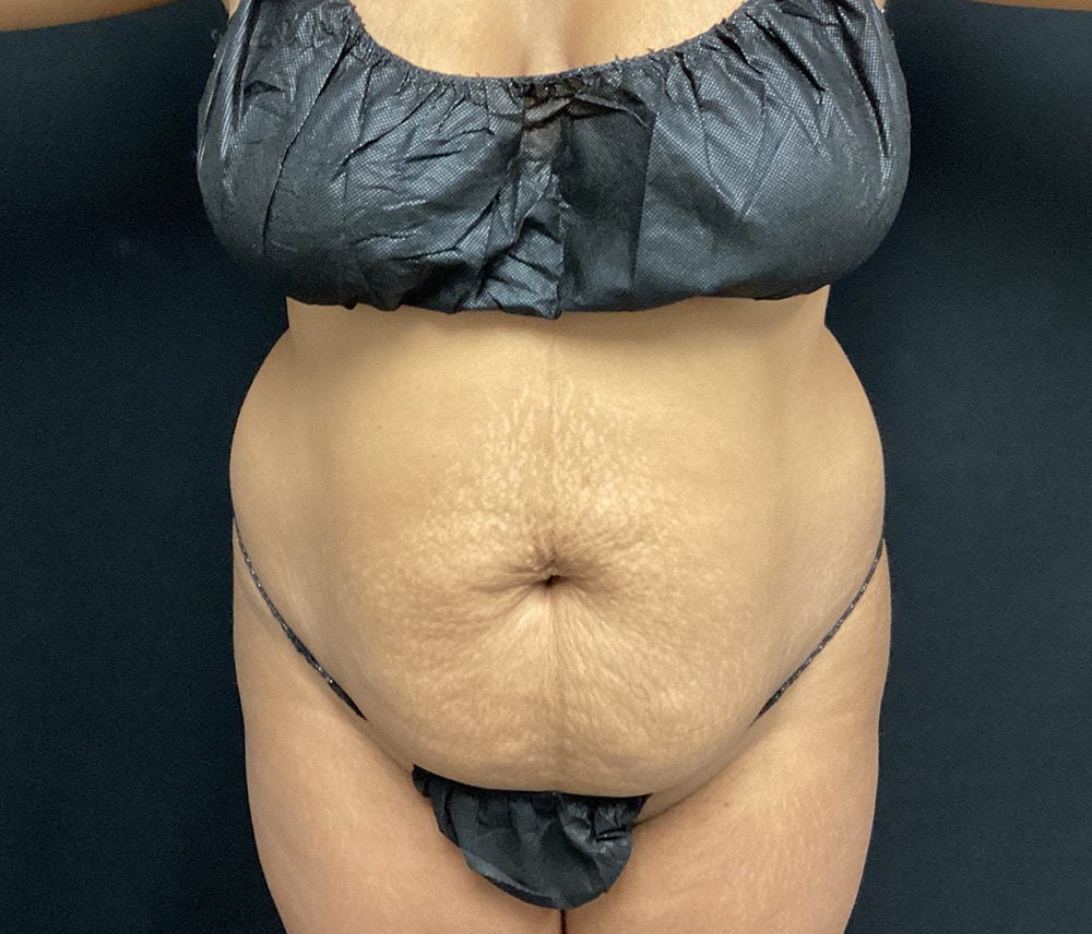 Liposuction Before & After Gallery - Patient 102620131 - Image 1
