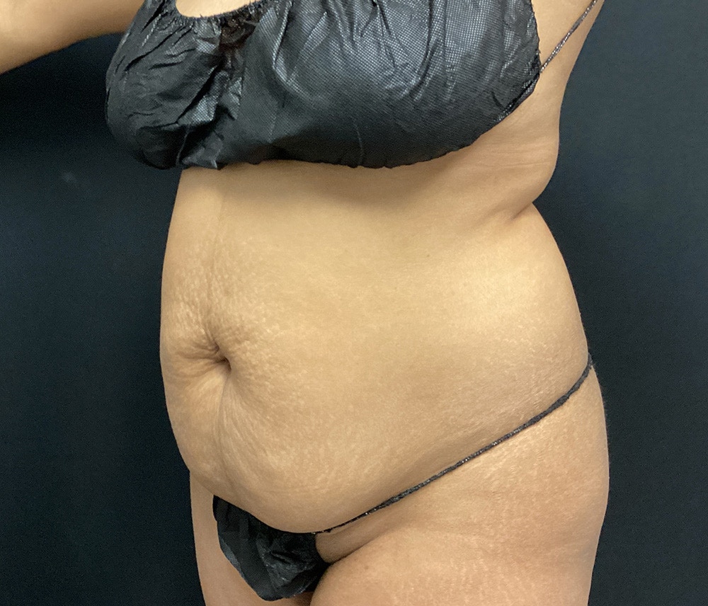 Lipo 360 Before & After Gallery - Patient 102620131 - Image 3