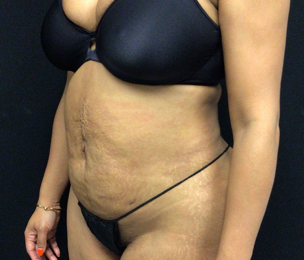 Liposuction Before & After Gallery - Patient 102620131 - Image 4