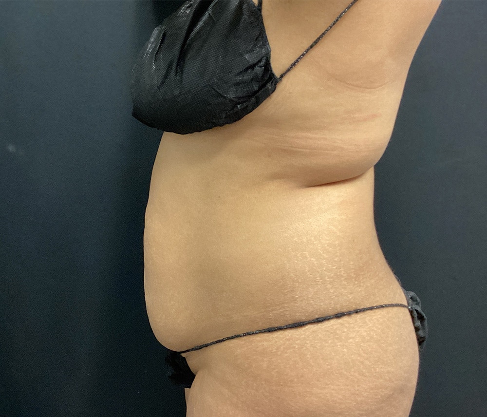 Liposuction Before & After Gallery - Patient 102620131 - Image 5