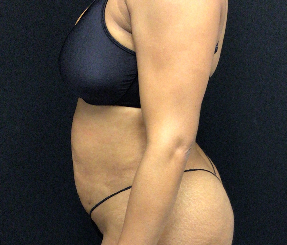 Liposuction Before & After Gallery - Patient 102620131 - Image 6