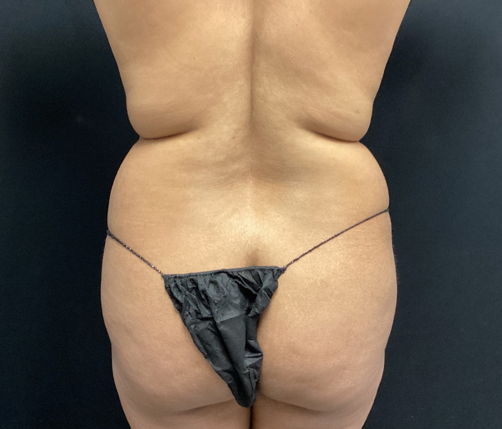 Liposuction Before & After Gallery - Patient 102620131 - Image 7