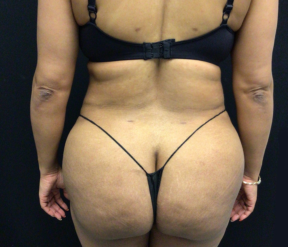 Lipo 360 Before & After Gallery - Patient 102620131 - Image 8