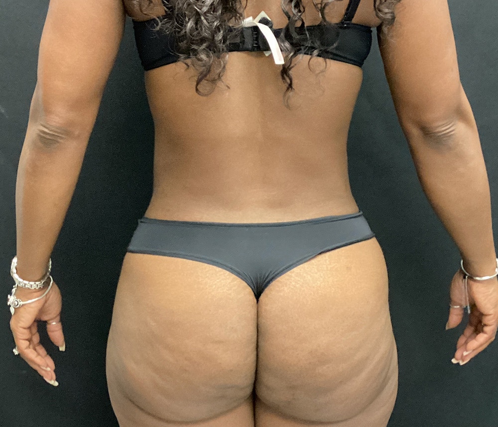 Liposuction Before & After Gallery - Patient 74784372 - Image 4