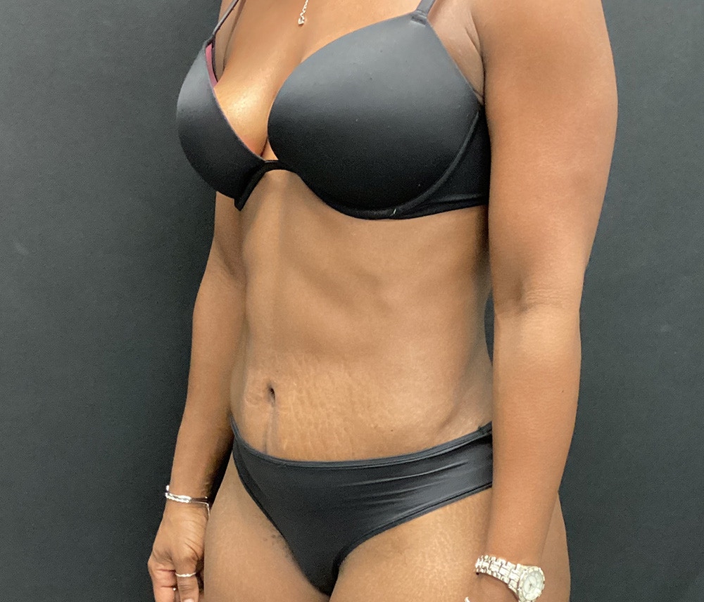 Liposuction Before & After Gallery - Patient 74784372 - Image 8