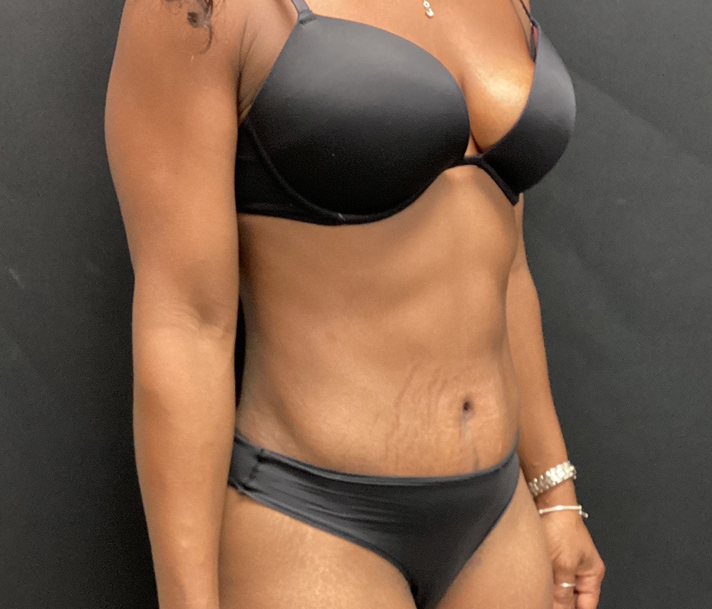 Liposuction Before & After Gallery - Patient 74784372 - Image 6