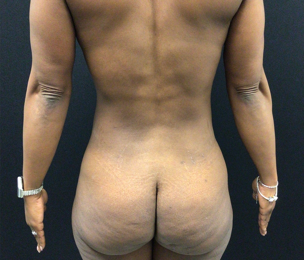 Liposuction Before & After Gallery - Patient 74784372 - Image 3