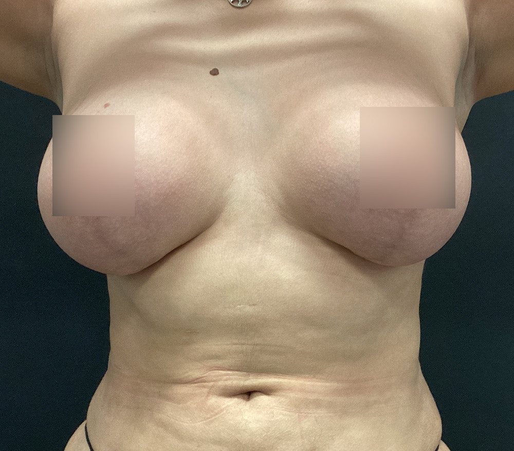 Breast Lift Before & After Gallery - Patient 102631666 - Image 2