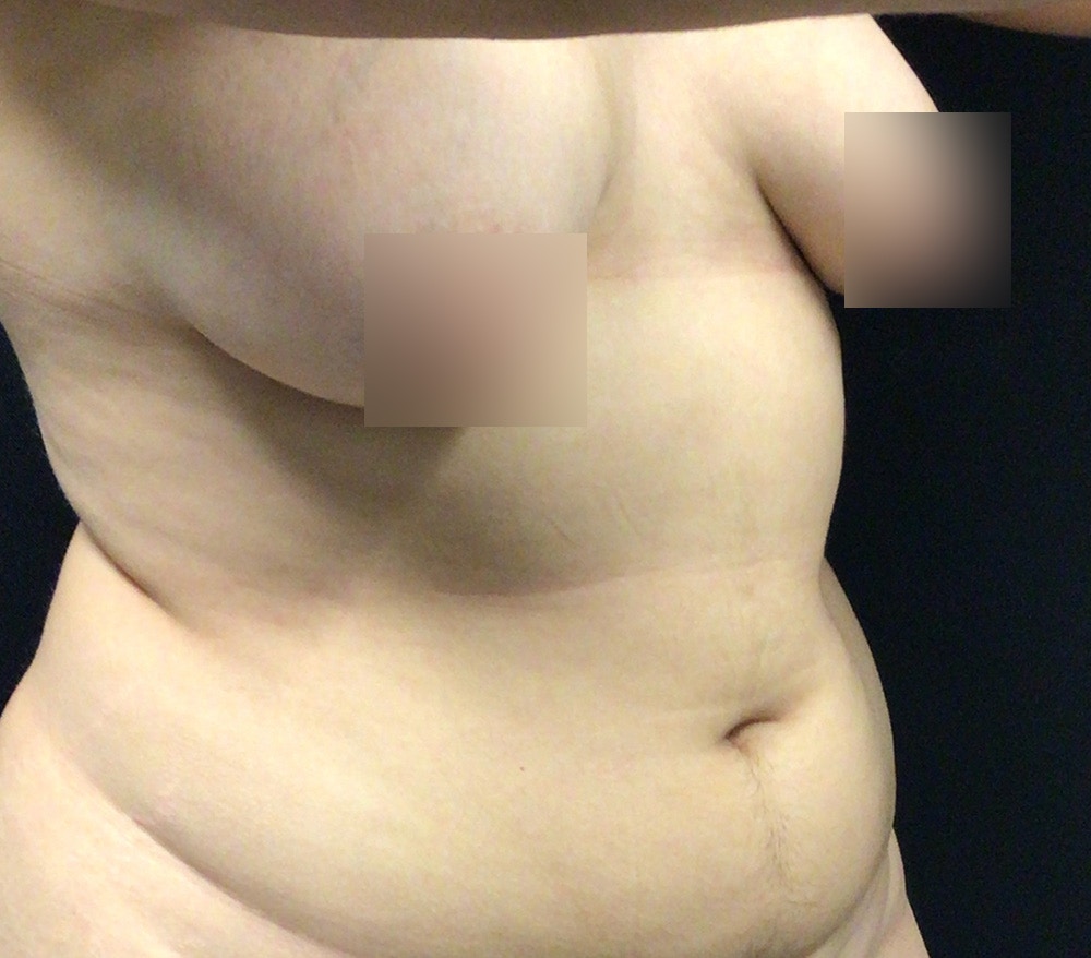 Breast Lift Before & After Gallery - Patient 102631666 - Image 3
