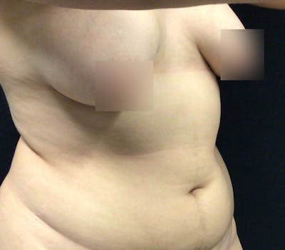 Breast Lift Before & After Gallery - Patient 102631666 - Image 3