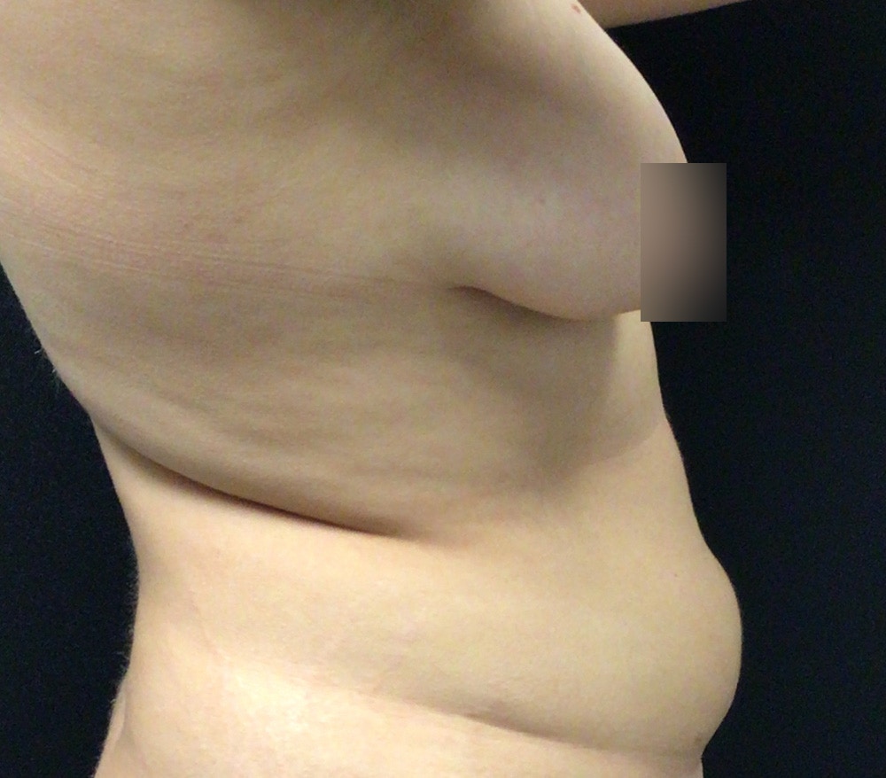 Breast Lift Before & After Gallery - Patient 102631666 - Image 5