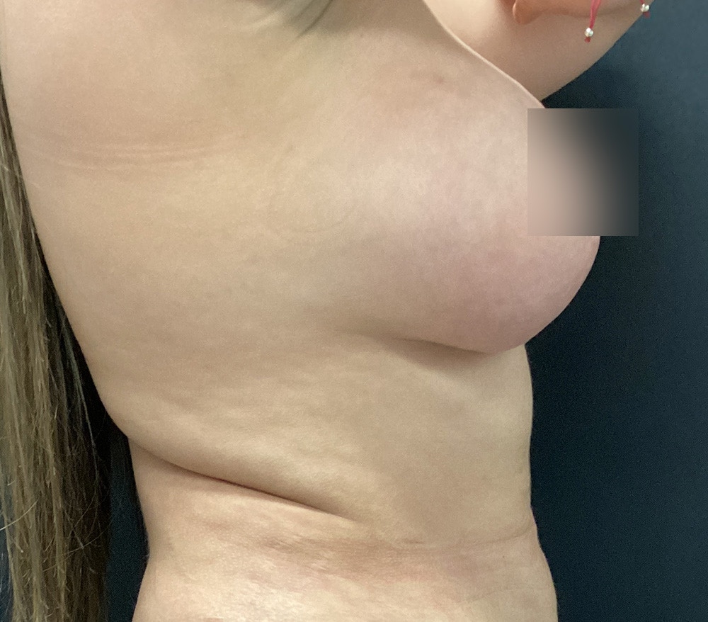Breast Lift Before & After Gallery - Patient 102631666 - Image 6