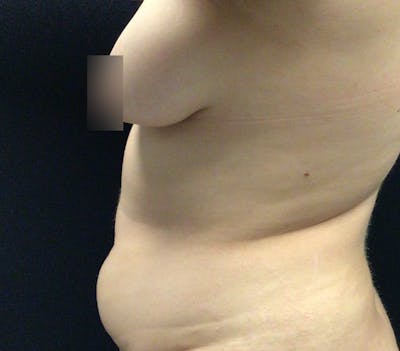 Breast Lift Before & After Gallery - Patient 102631666 - Image 7