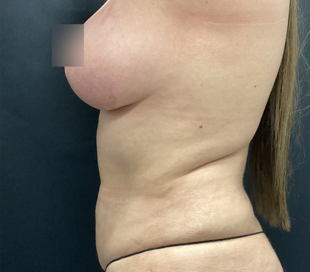 Breast Lift Before & After Gallery - Patient 102631666 - Image 8