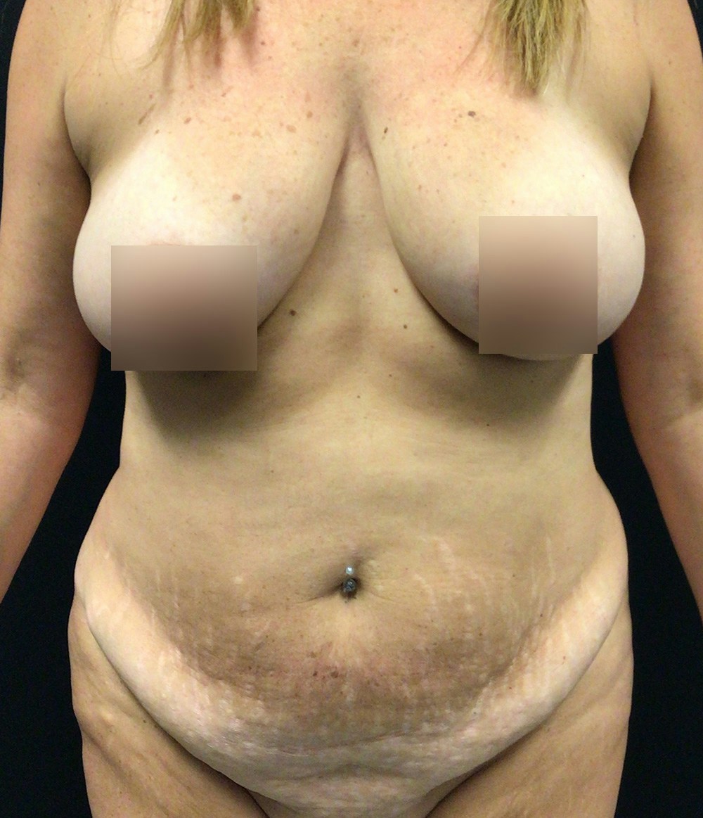 Tummy Tuck Before & After Gallery - Patient 102682444 - Image 1