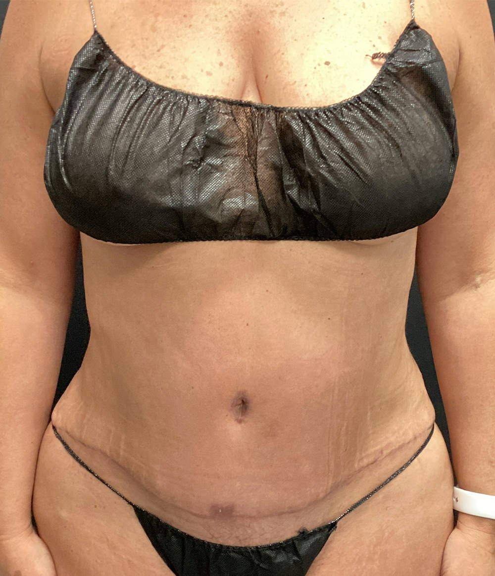 Tummy Tuck Before & After Gallery - Patient 102682444 - Image 2