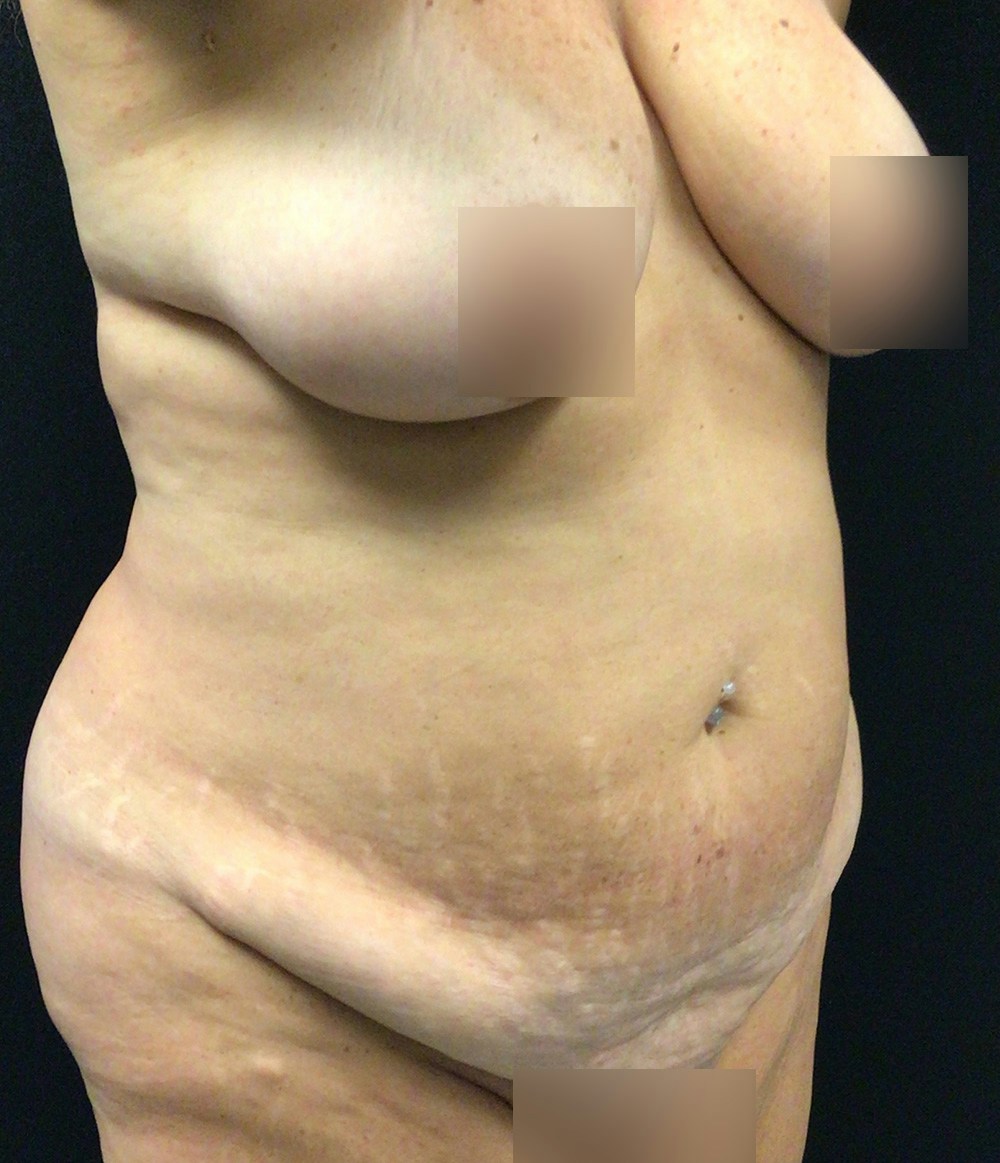 Tummy Tuck Before & After Gallery - Patient 102682444 - Image 3