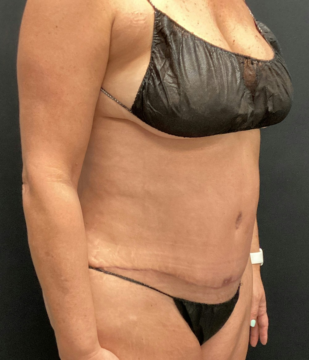 Tummy Tuck Before & After Gallery - Patient 102682444 - Image 4