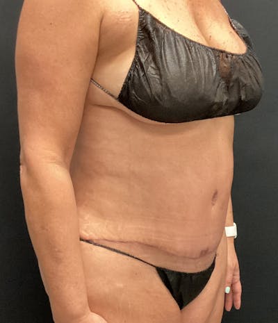 Tummy Tuck Before & After Gallery - Patient 102682444 - Image 4