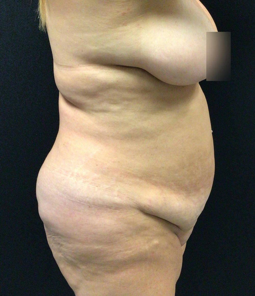 Tummy Tuck Before & After Gallery - Patient 102682444 - Image 5