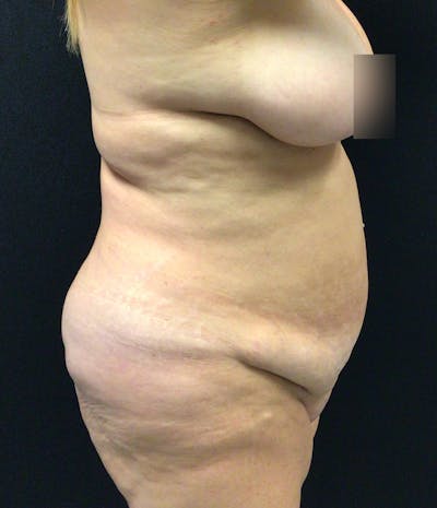 Tummy Tuck Before & After Gallery - Patient 102682444 - Image 5